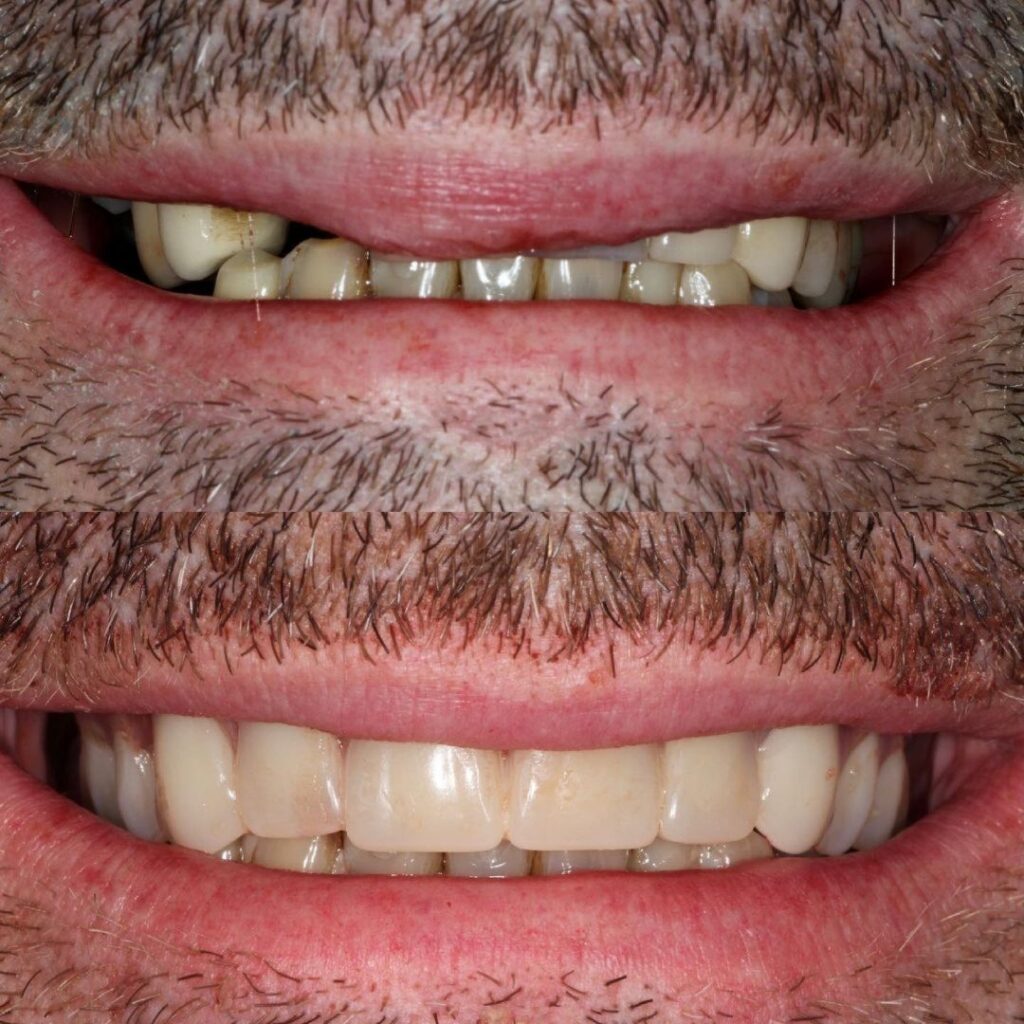 dental implants glasgow