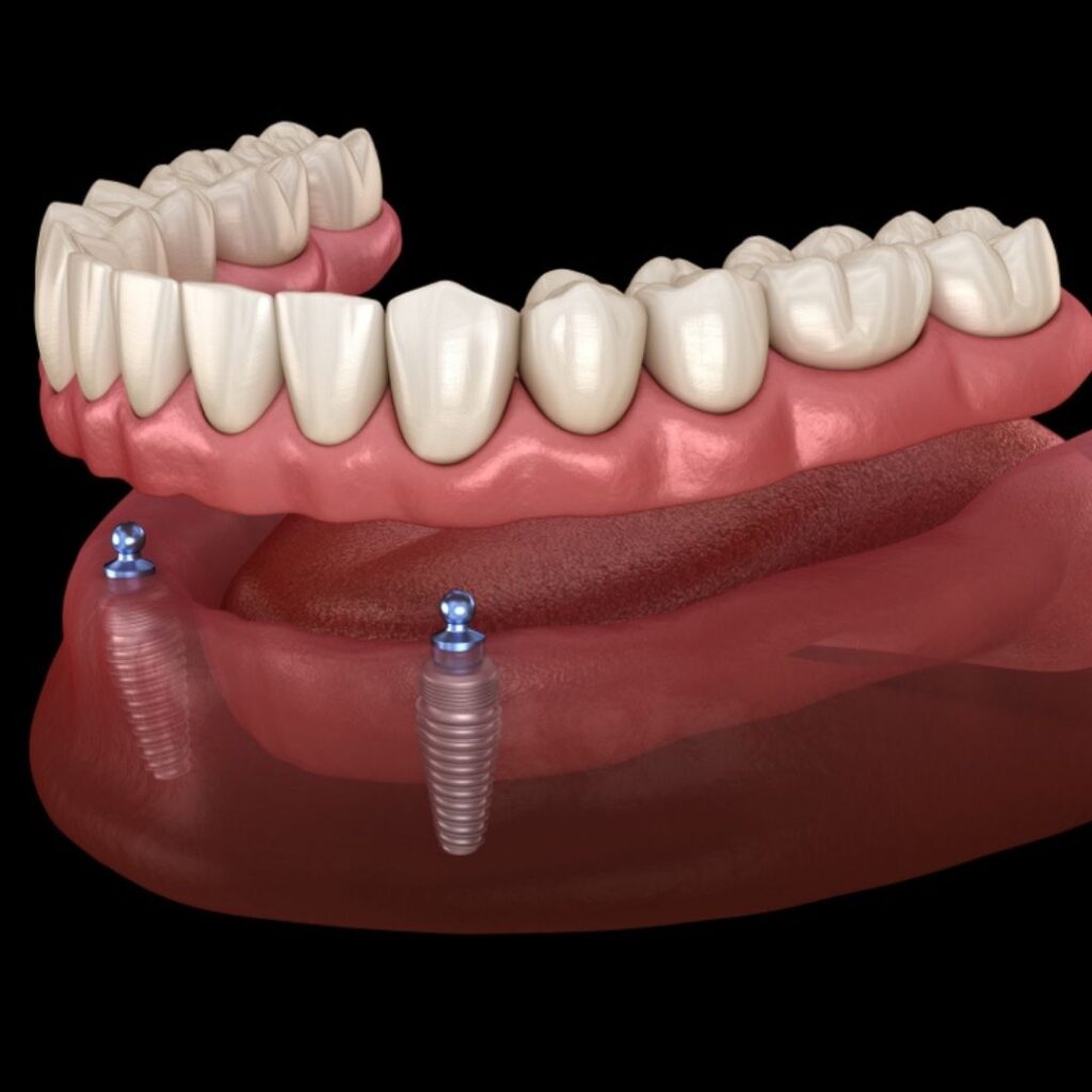 full arch dental implants