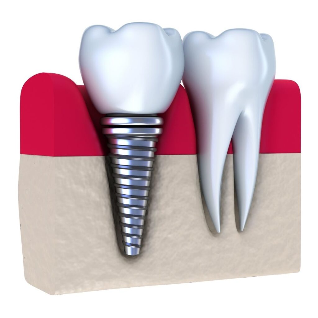 single dental implant